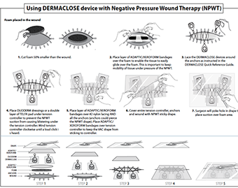 Negative Pressure Wound Therapy (NPWT)