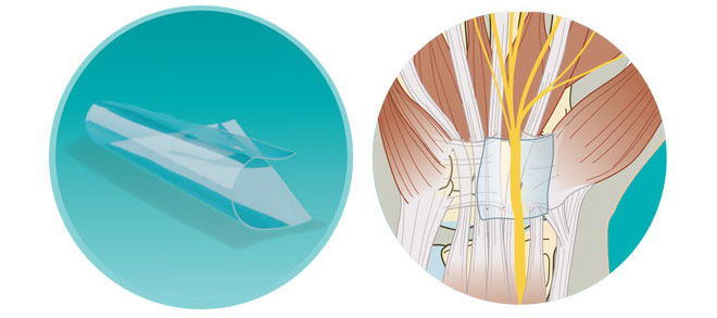 NEUROCAP NERVE CAPPING DEVICE